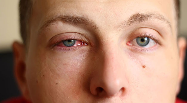 Воспалительные заболевания глаз - лечение, причины, симптомы