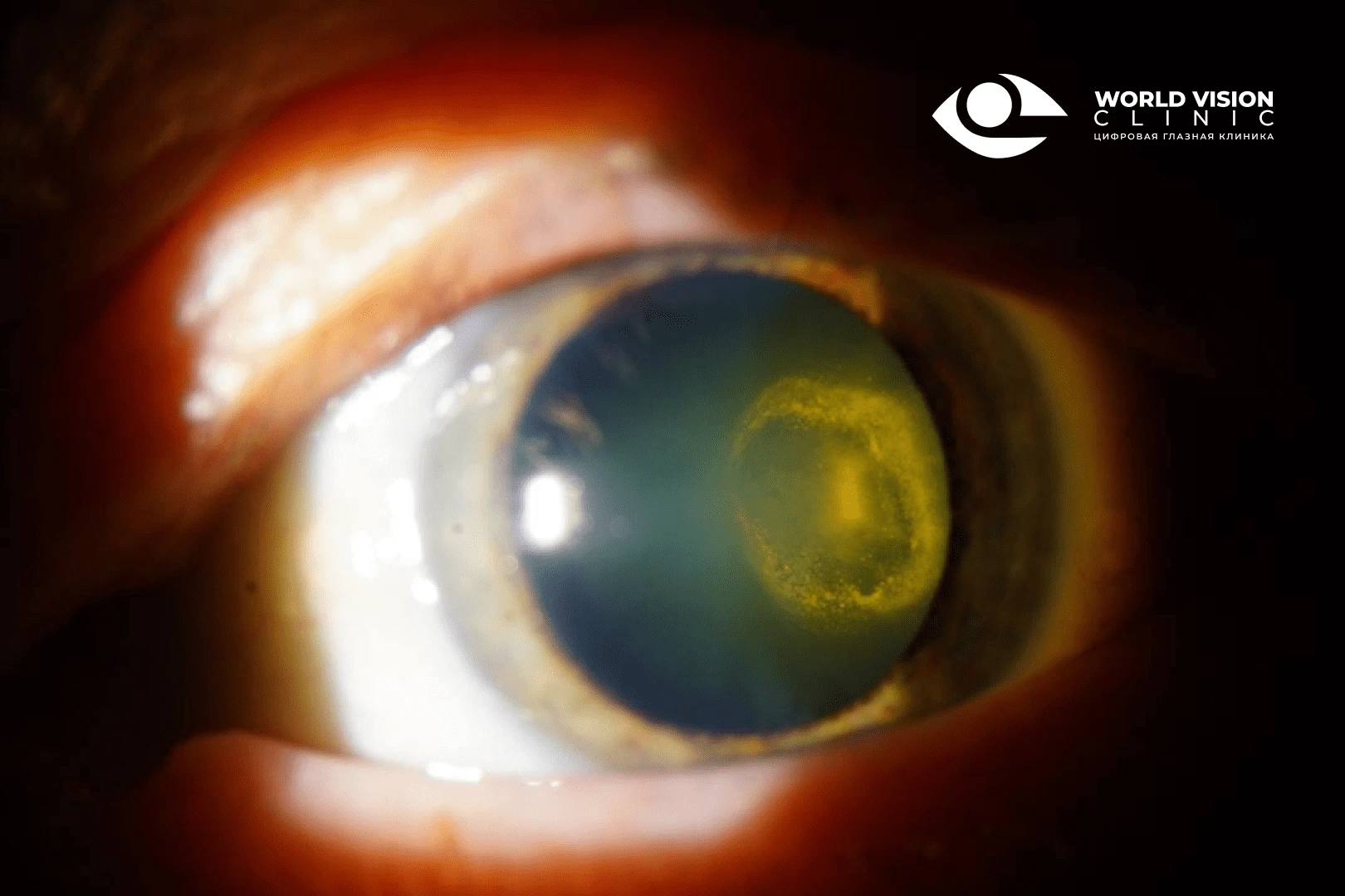 Осложненная катаракта: причины и лечение